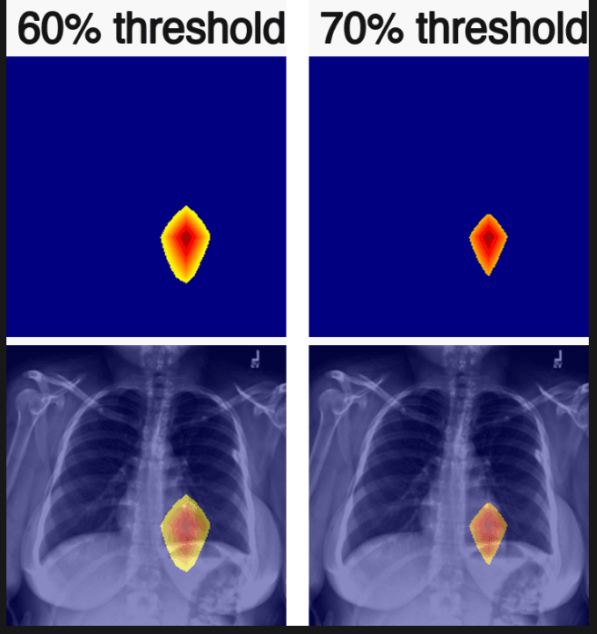Grad-CAM++ activation regions at 60 percent and 70 percent of the heatmap maximum, overlaid on a chest X-ray.
