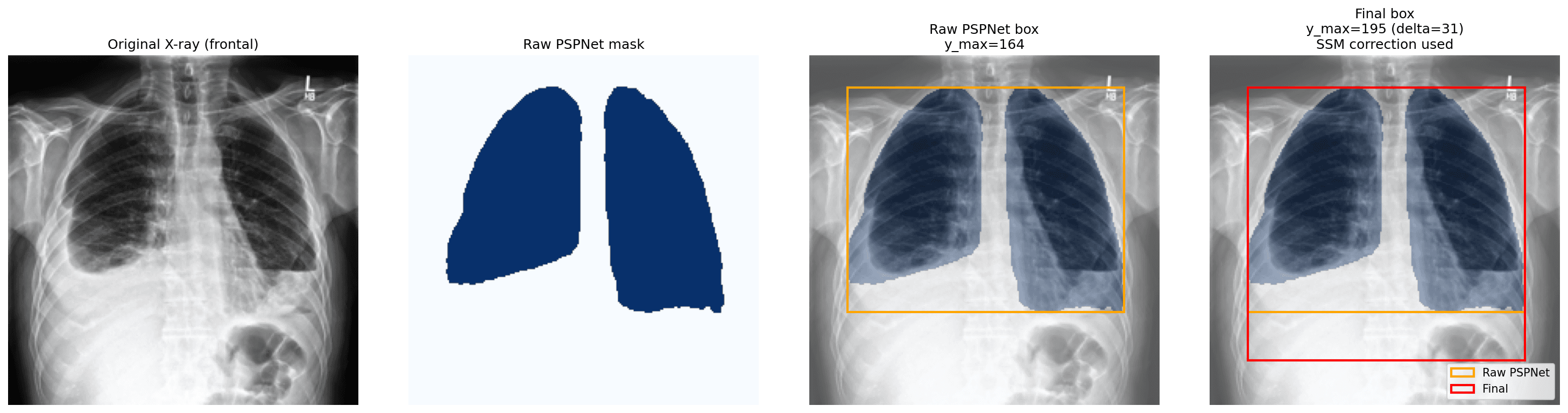 Four panels: the original frontal X-ray, the raw PSPNet mask, the raw PSPNet bounding box in orange stopping at the fluid line, and the SSM-corrected bounding box in red at the true lung base.