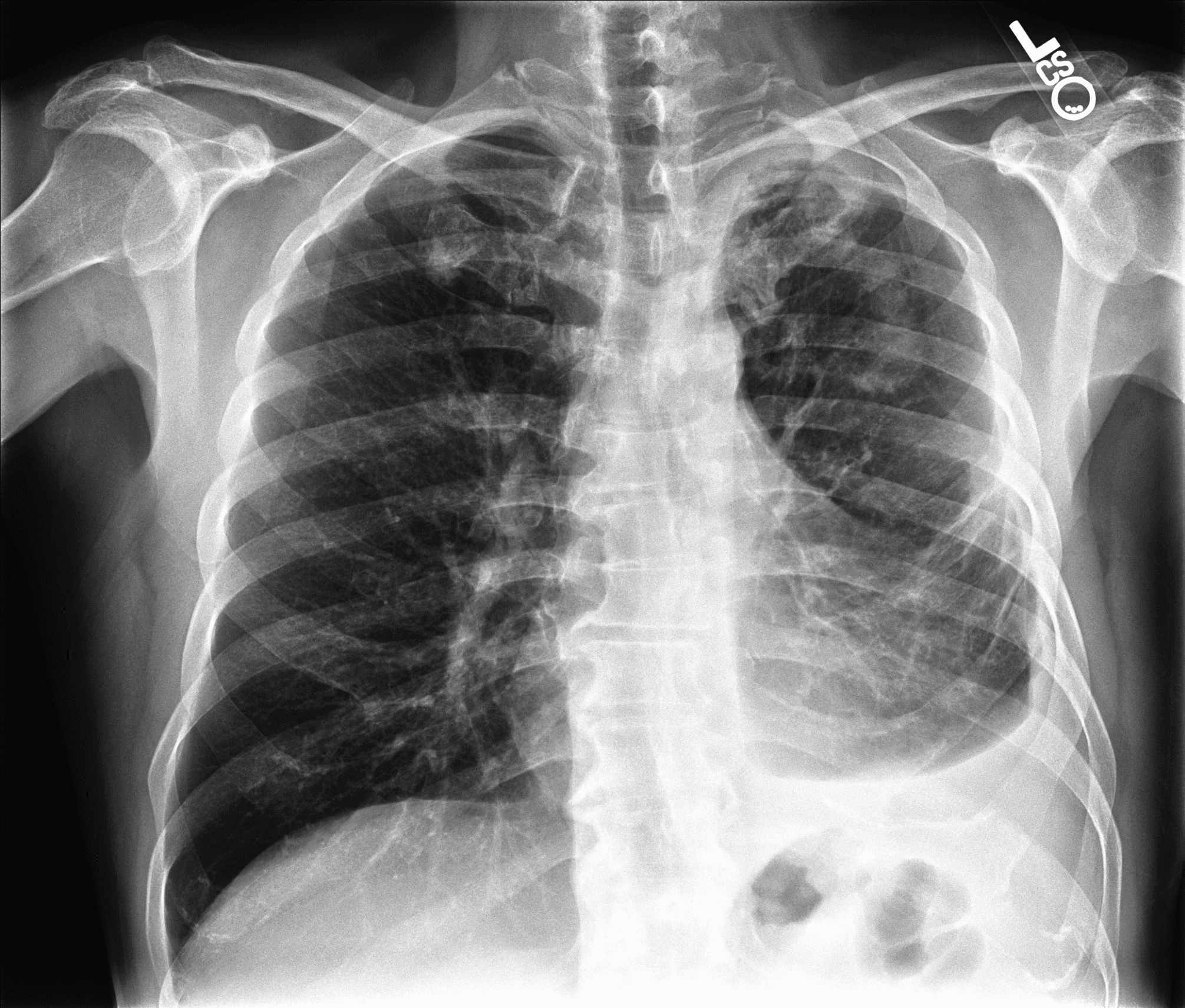 Frontal (PA) chest radiograph of patient 00414.