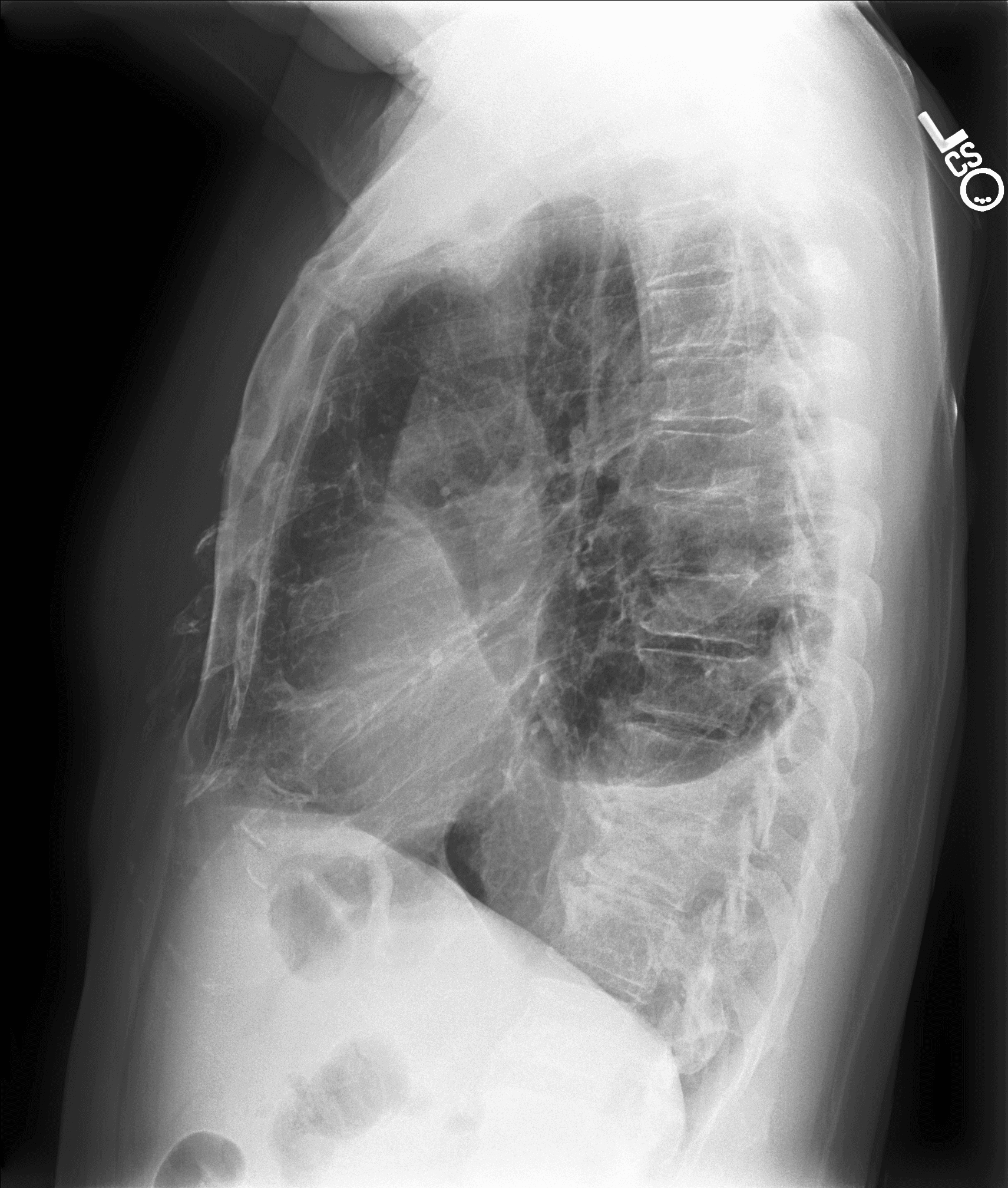 Lateral chest radiograph of patient 00414.