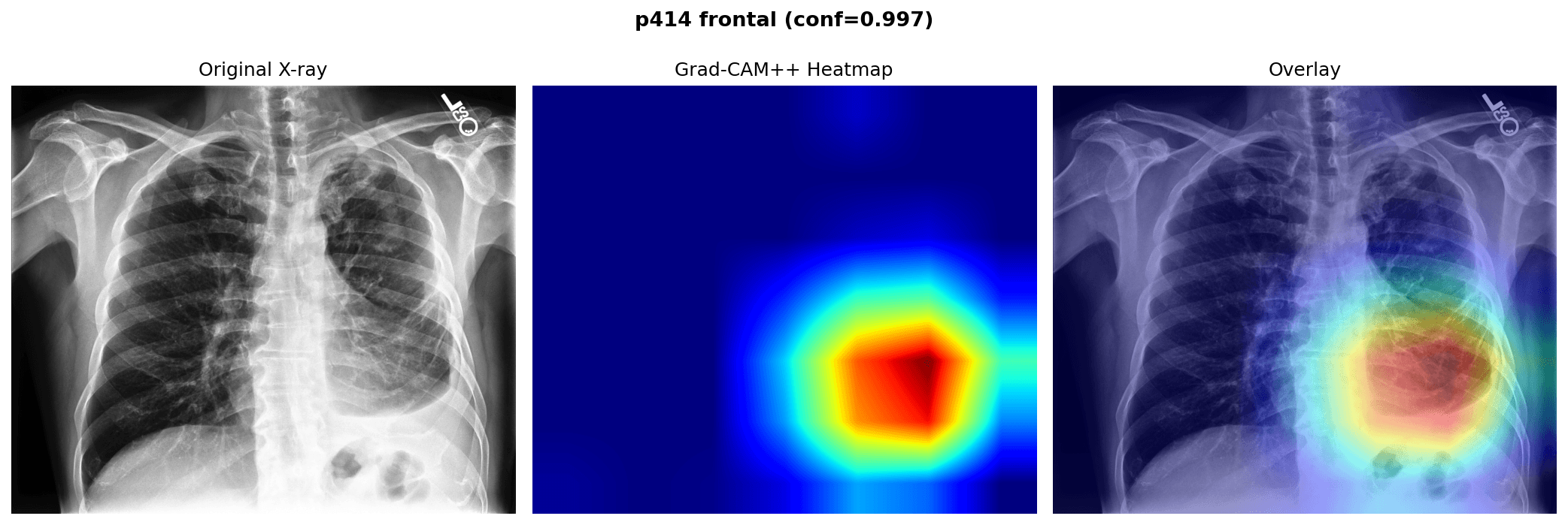 Grad-CAM++ heatmap overlay on the frontal radiograph of patient 00414.