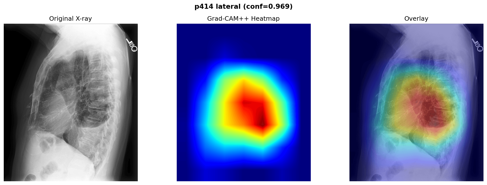 Grad-CAM++ heatmap overlay on the lateral radiograph of patient 00414.