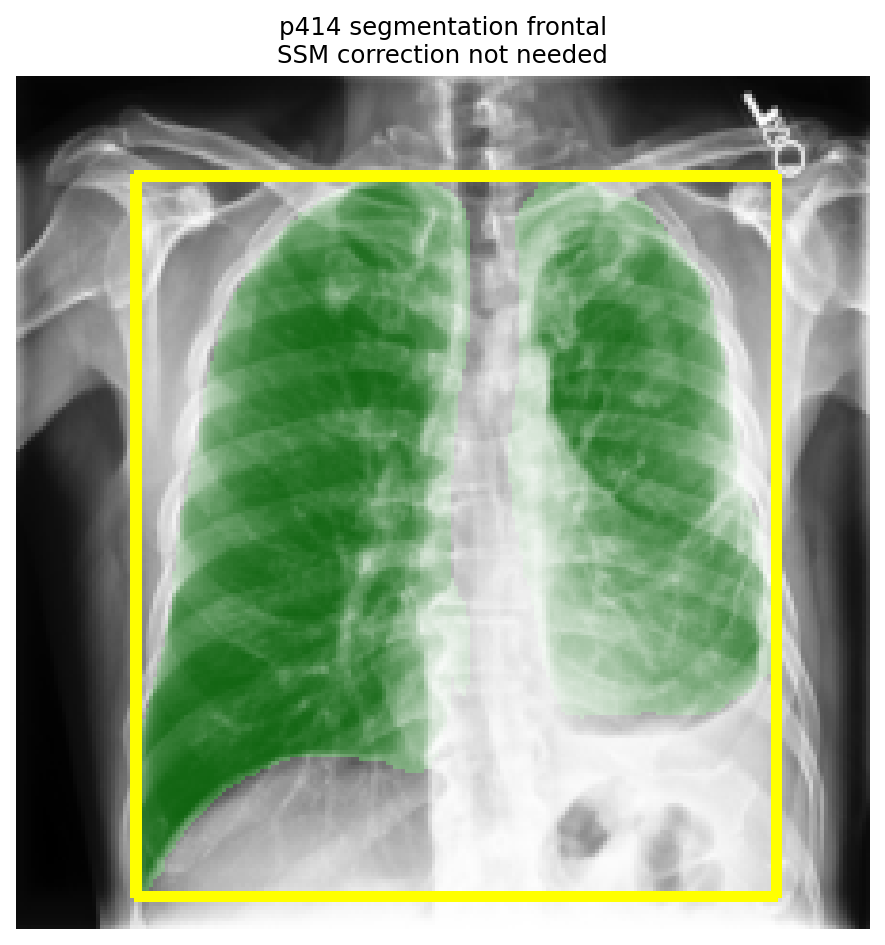 PSPNet lung segmentation and bounding box on the frontal radiograph of patient 00414.