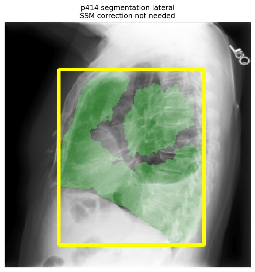 PSPNet lung segmentation on the lateral radiograph of patient 00414 after keeping only the two largest components.