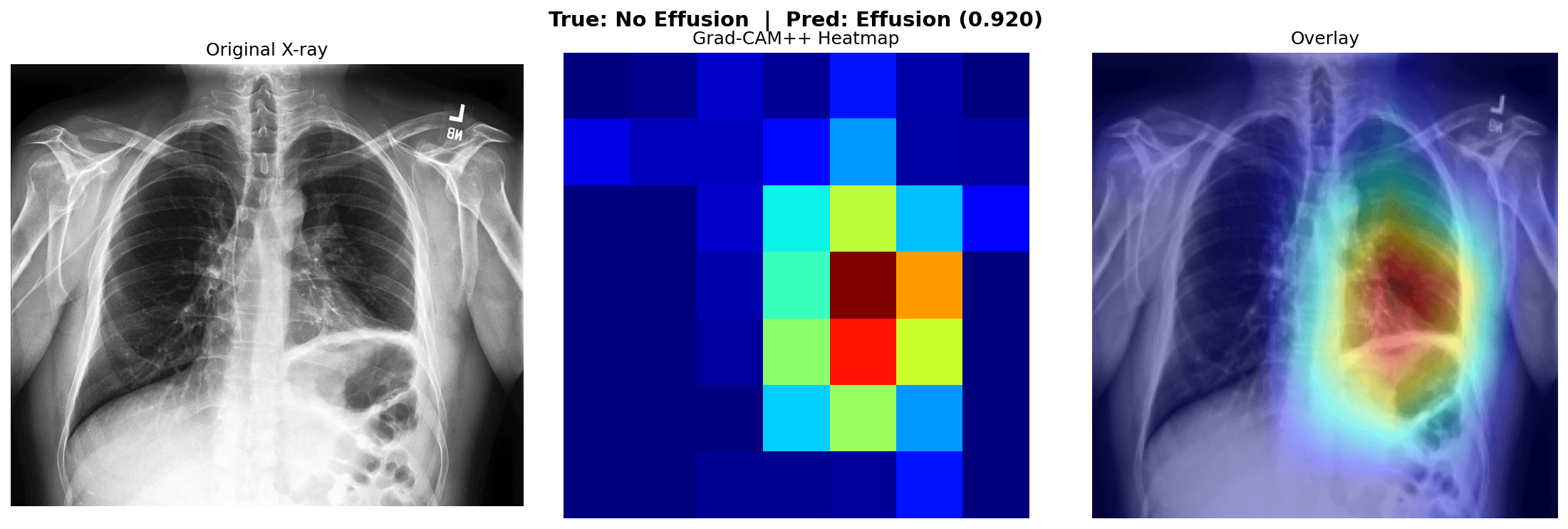 A false-positive chest X-ray (true label no effusion, predicted effusion) with its Grad-CAM++ heatmap and overlay.