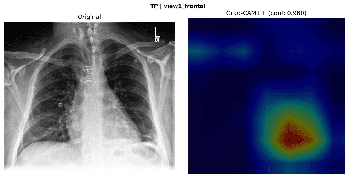 Case 1: frontal chest X-ray beside its Grad-CAM++ overlay with activation in the lower lung field.