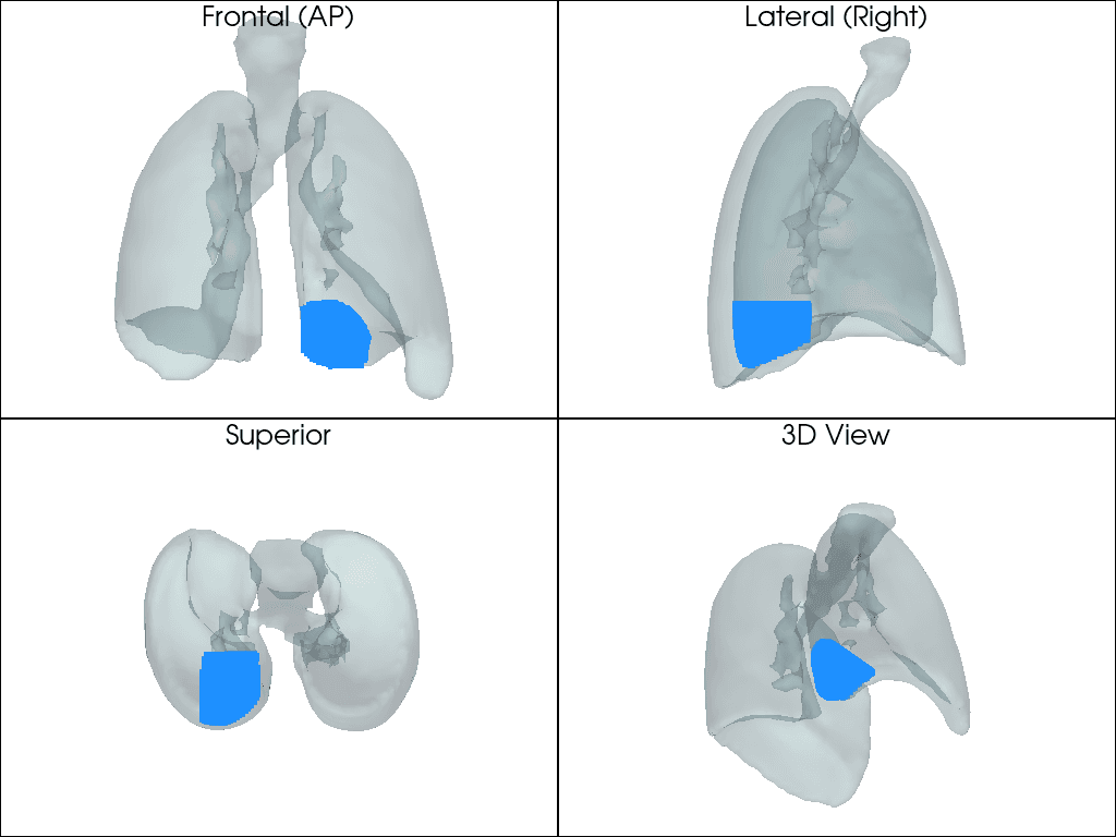 Case 1: four views of the 3D lung model with the rendered region at the lung base.