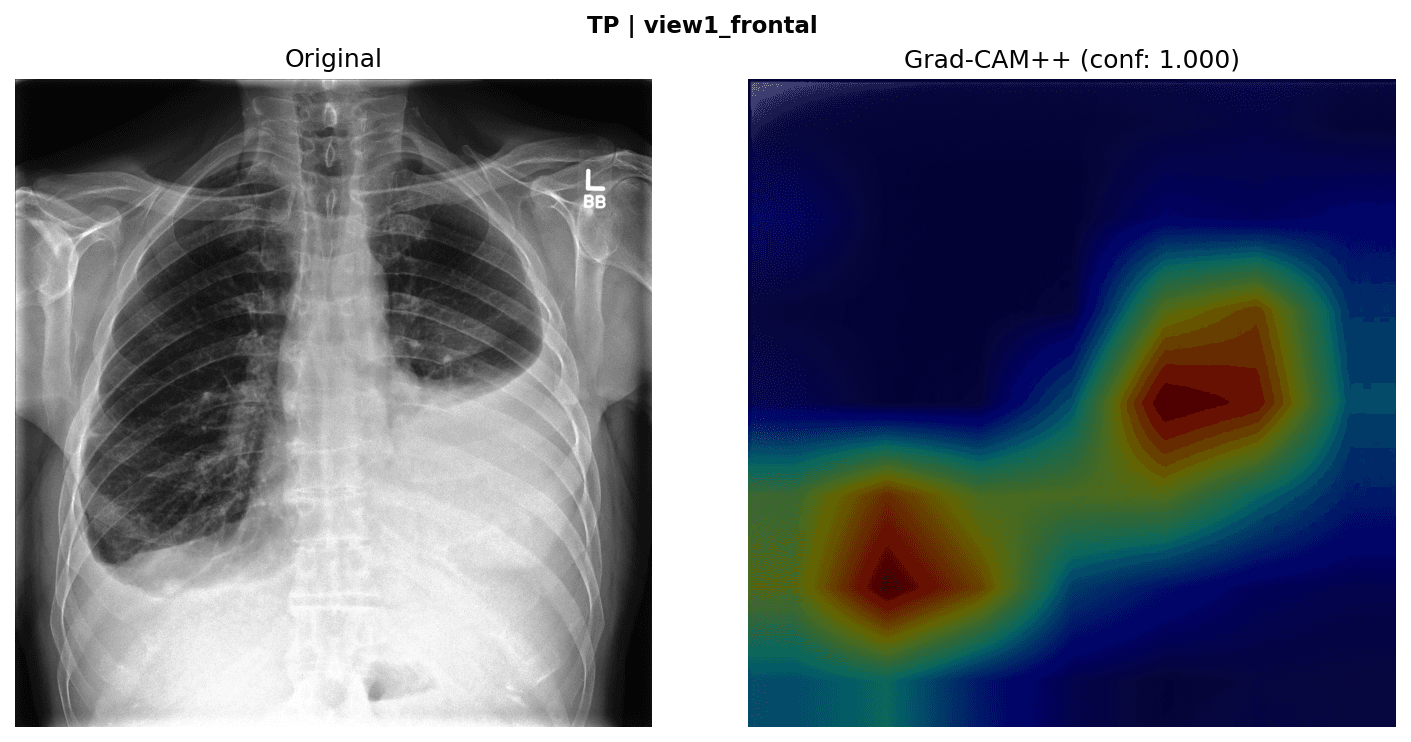 Case 2: frontal chest X-ray beside its Grad-CAM++ overlay with two separate regions of activation in the lower lung fields.