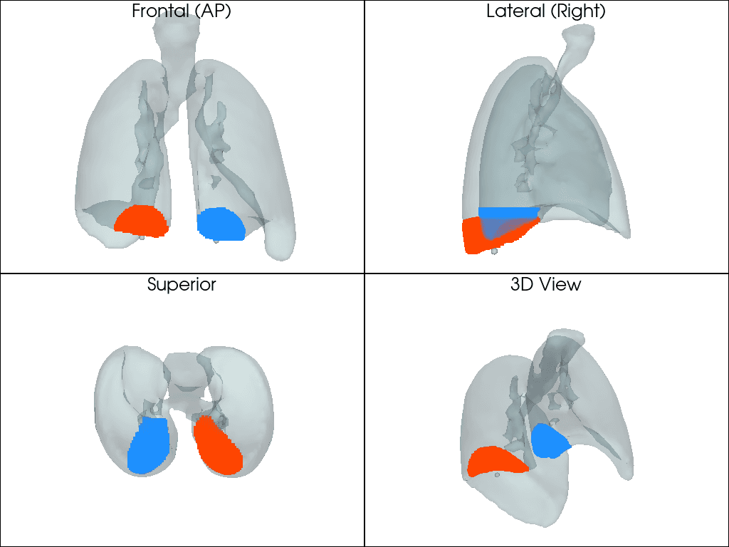 Case 2: four views of the 3D lung model with rendered regions in both lungs at the lung base.