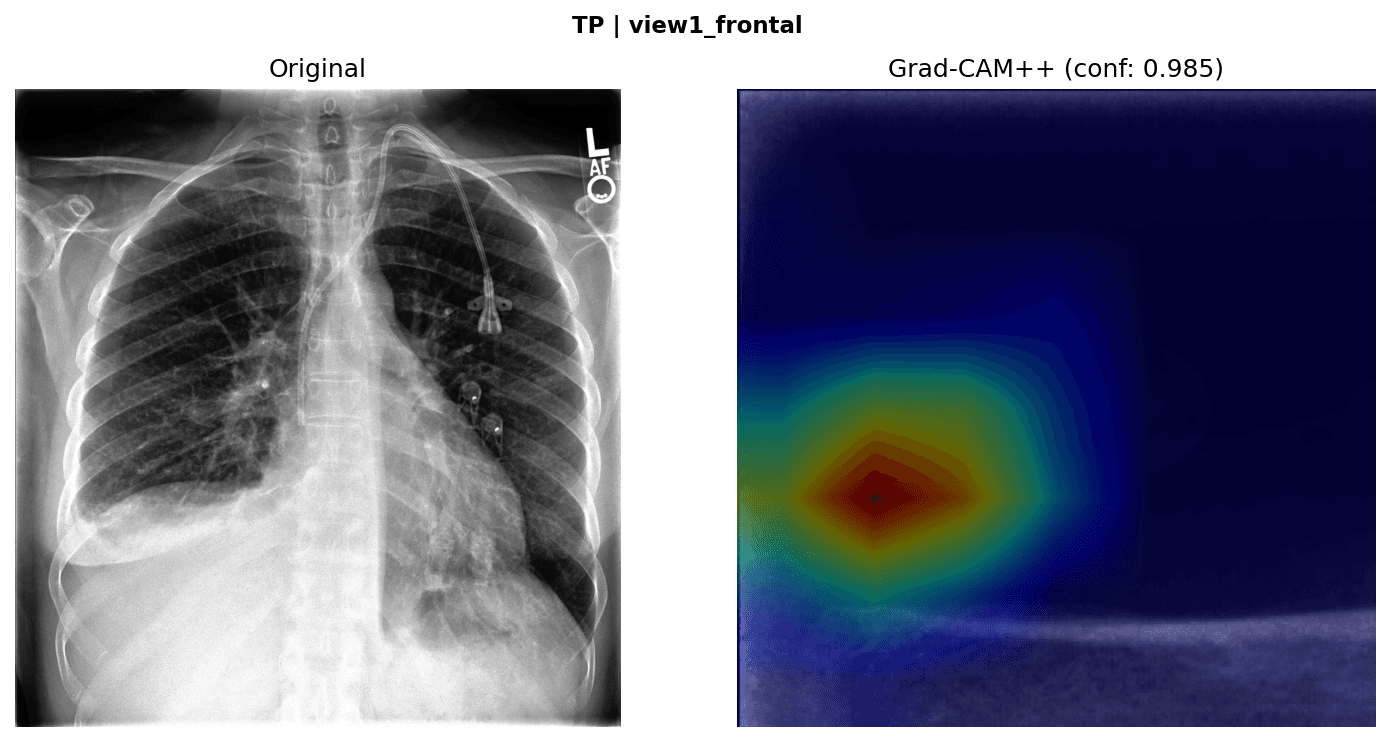 Case 3: frontal chest X-ray beside its Grad-CAM++ overlay with activation in the lower lung field.