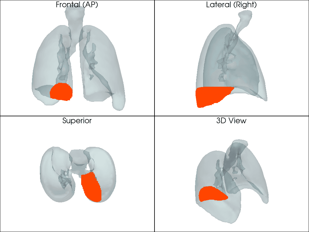 Case 3: four views of the 3D lung model with the rendered region at the inferior posterior part of one lung.
